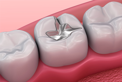 man smiling after having his amalgam fillings removed in Hayden, ID